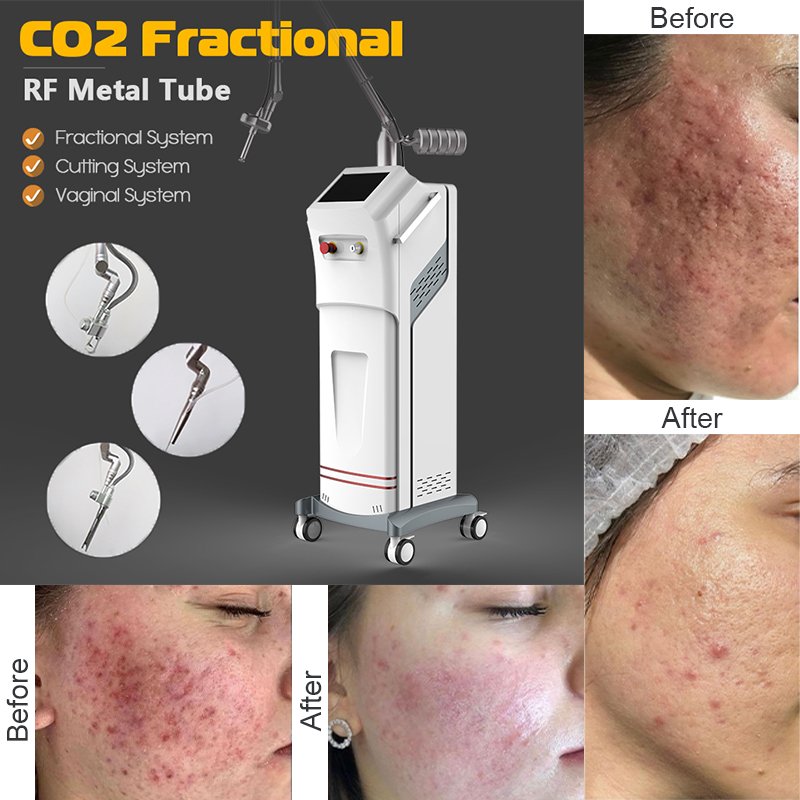No.1 Professional CO2 Fractional Laser Beauty Machine 1 Professional CO2 Fractional Laser Beauty Machine