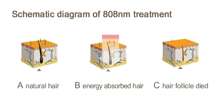 808nm laser hair removal principle