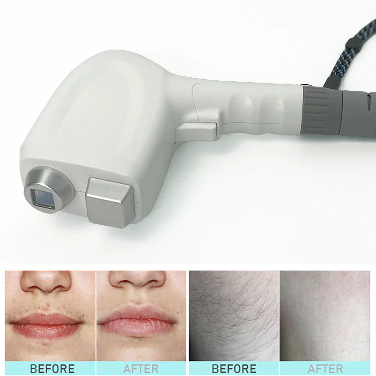 diode laser AH hair removal