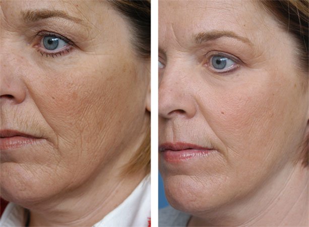 No.1 Professional CO2 Fractional Laser Beauty Machine 3 Professional CO2 Fractional Laser Beauty Machine