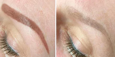 laser-tattoo-removal-by-nd-yag-laser-4.webp