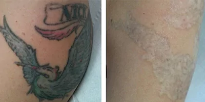 laser-tattoo-removal-by-nd-yag-laser-5.webp
