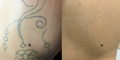 laser-tattoo-removal-by-nd-yag-laser-6.webp