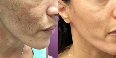 pigmentation-therapy-by-beauty-laser-1.webp