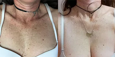 pigmentation-therapy-by-beauty-laser-2.webp