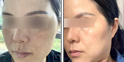 skin rejuvenation by beauty machine (1)