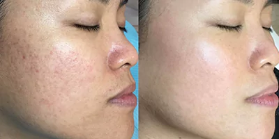 skin-rejuvenation-by-beauty-machine-3.webp