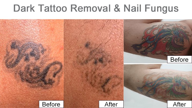 No.1 Professional ND YAG Tattoo Removal Carbon Peeling Beauty Machine 3 去纹身1