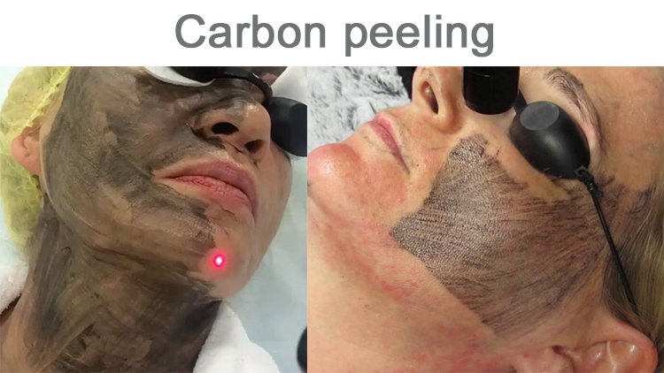 No.1 Professional ND YAG Tattoo Removal Carbon Peeling Beauty Machine 2 ND YAG Tattoo Removal Carbon Peeling Beauty Machine
